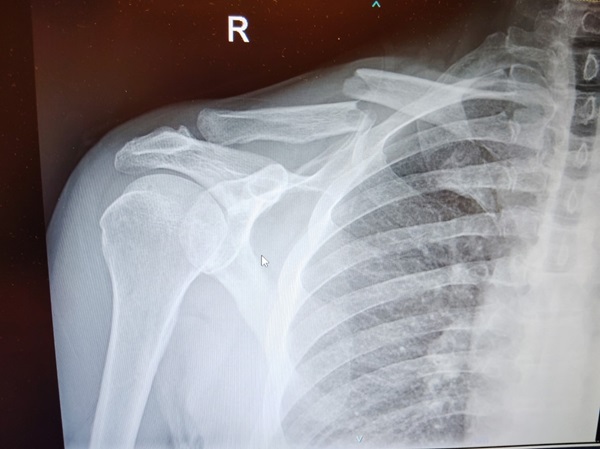 A broken displaced clavicle X-ray suffered by a car accident victim that was represented by Attorney Colin Scott.