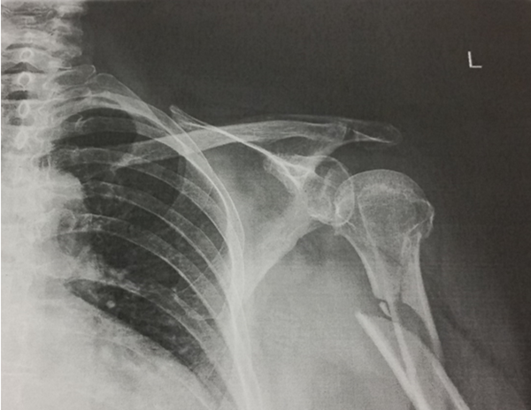 X-ray image showing a displaced fracture of the left humerus near the shoulder joint.